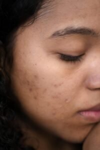 Hormonal acne and natural skincare treatment